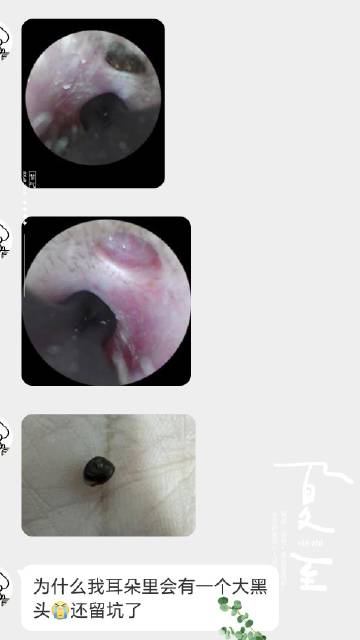 赵医生最新耳道清洁教程视频